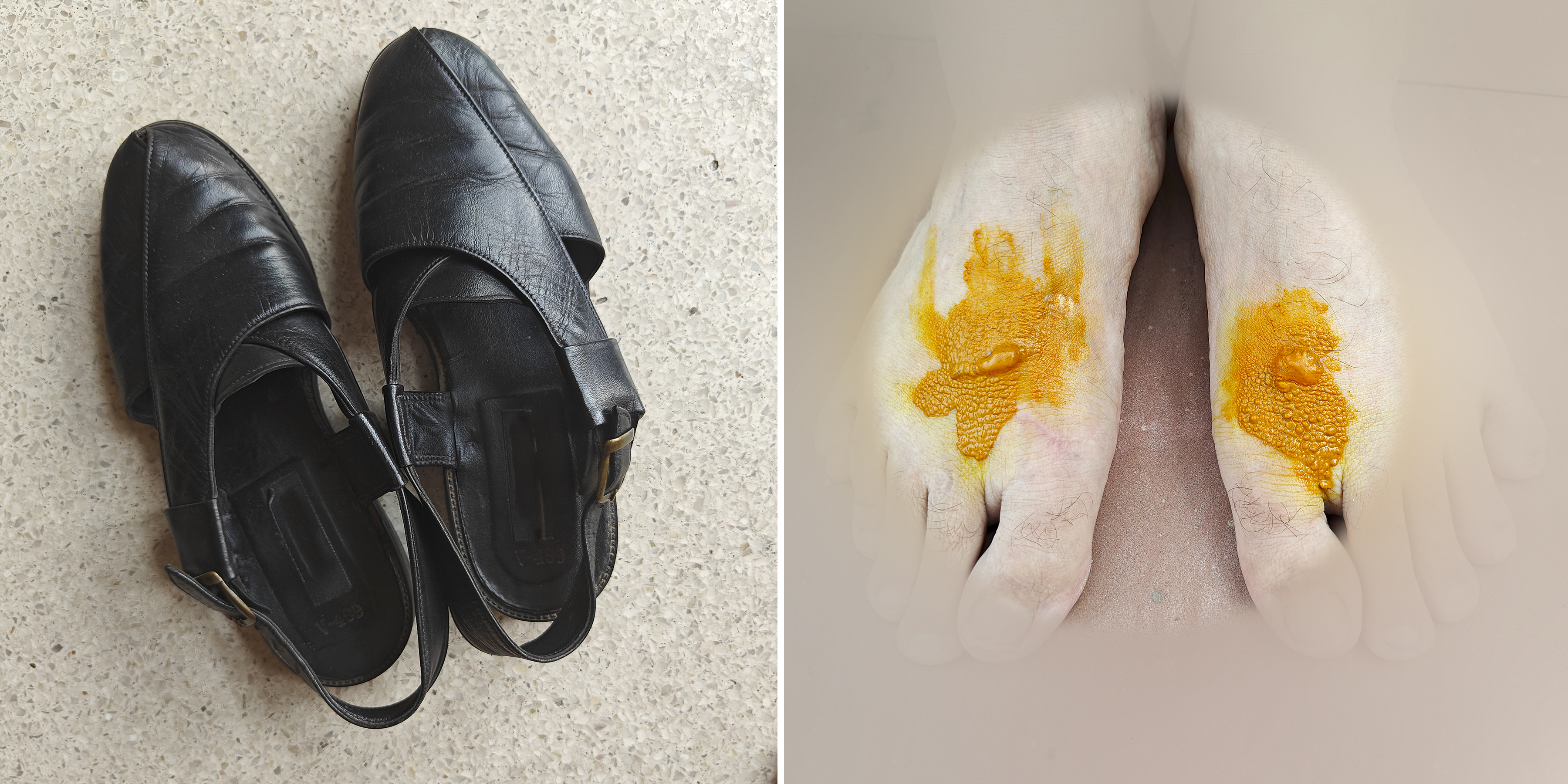 feet with ulcers or boils induced by shoes